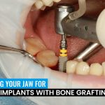 bone-grafting