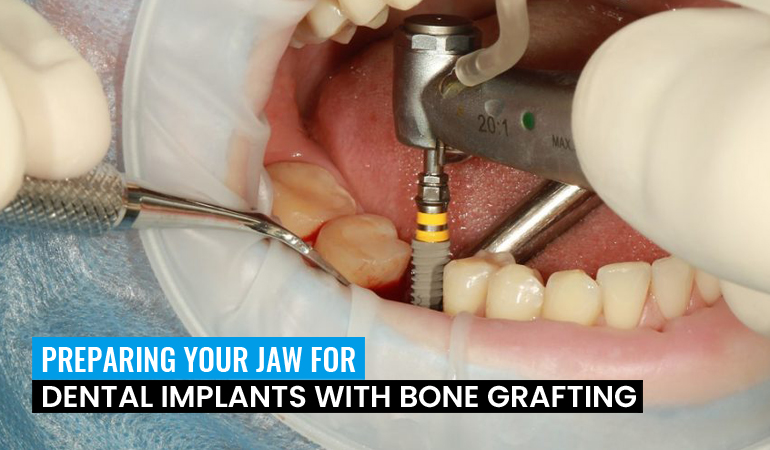 bone-grafting
