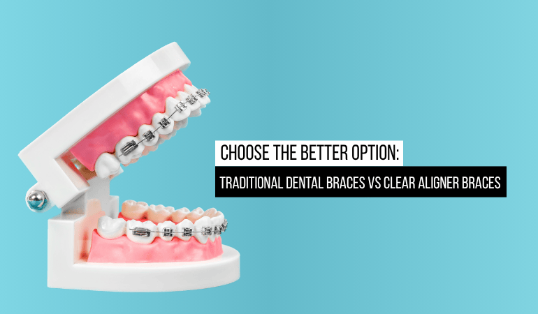 Dental-Braces