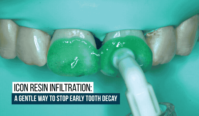 icon-resin-infiltration