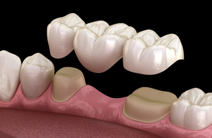 Dental Bridges