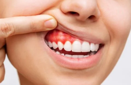 Gingivitis Treatment