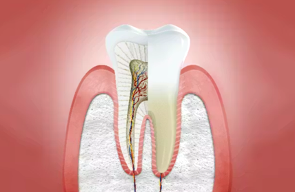 Periodontitis