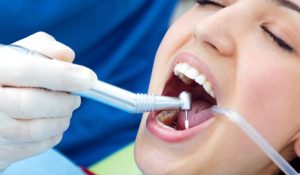 Dental-Restoration-Services-in-Davie
