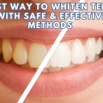 What-Is-the-Best-Way-to-Whiten-Teeth-Safe-Effective-Methods-Explained