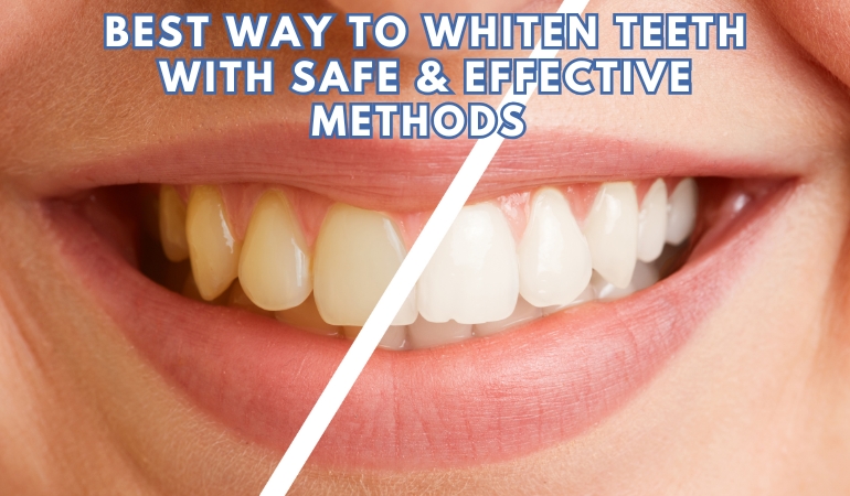 What-Is-the-Best-Way-to-Whiten-Teeth-Safe-Effective-Methods-Explained