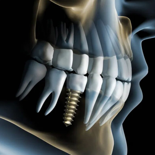 implant-1