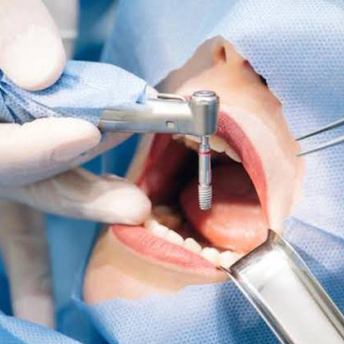 implant-4